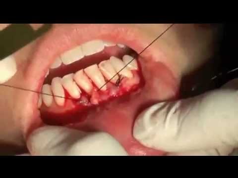 Gum Graft Surgery - Periodontal Tunneling Procedure