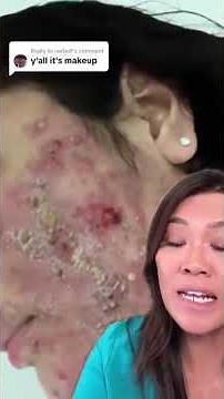 Here's a reminder that there are other, sometimes more severe types of acne besides Acne Vulgaris