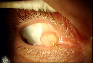 11 reactions | Conjunctival Cyst | Dr. Benjamin Karimov | Facebook