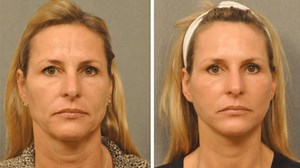 Before and After Photos: See the Results of These Mid-Face and Neck Lifts
