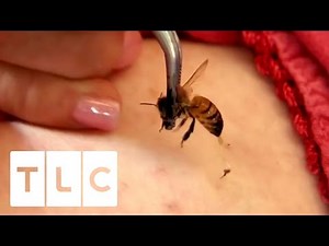 15 Bee Stings A Day | My Strange Addiction