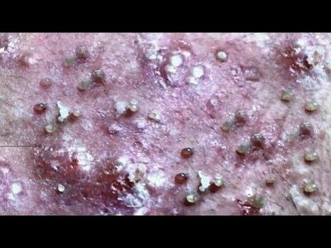 cystic acne treatment, big acne removal compilation