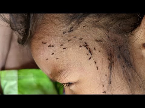 How to remove lice from from short hair - Getting out all hundred lice from head