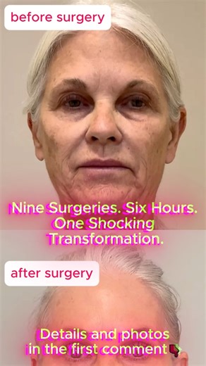 The bright lights of the operating room glared as the clock ticked past hour four. Surgeons leaned in, scalpels steady, while Lisa, a 66-year-old grandmother, lay completely still. Nine different procedures in one day. Six hours under anesthesia. One radical gamble to turn back the clock. When she finally opened her eyes, even the nurses gasped—was this really the same woman? Full story and photos in the first comment 👇 | Furry, Famous, and Fun