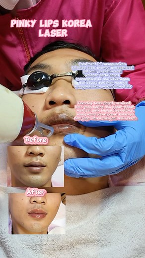 22K views · 13 reactions | Promo laser bibir cuma 100rb-an @gloglowingaesthetic @gloglowing_japanesespa | Indramayu Info | Facebook