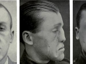 How WWI Facial Injuries Gave Rise to Modern Plastic Surgery