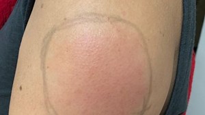 Vaccine side effect "COVID arm" can develop later in some people