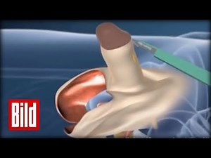 Vom Penis zur Vagina - So funktioniert eine Geschlechtsumwandlung / Animation