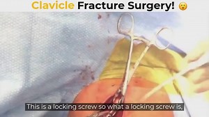 23 reactions | Another Monday tackling a fracture surgery! Typically, the only time I fix displaced clavicle fractures is when the shoulder and breast bones are significantly overlapped. | Dr. Jason Hammond | Facebook