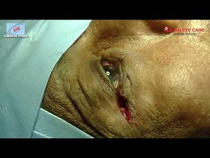 Entropion Correction With Lateral Tarsal Strip with everting suture by Dr. C. Senthil Nathan