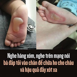 109K views · 25 reactions | Cách chữa mẹo dân gian này không biết có hiệu quả hay không nhưng hậu quả ngay tức thì chính là khiến chân con trẻ bị phồng rộp đầy đau đớn! Chia sẻ để cảnh báo các bậc cha mẹ, ông bà không làm theo các mẹo dân gian để con cháu mình phải chịu đau đớn! Xem thêm Video định dạng Mutex tại #Mutex #Nn #Kx | aFamily.vn | Facebook