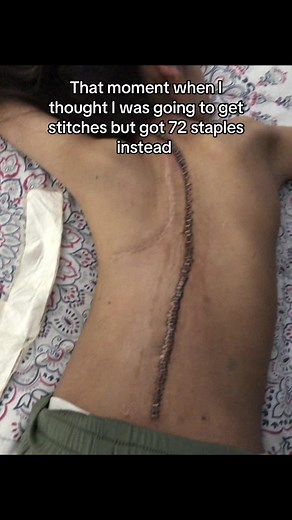 Scoliosis Surgery: 72 Staples, No Stitches | Spinal Fusion Recovery