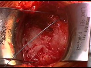 Open Rotator Cuff Repair Dr Terry Hammond.dv