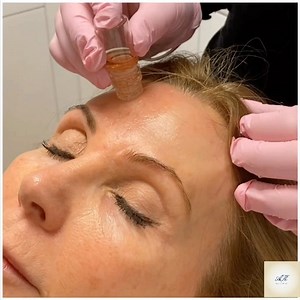 1.7K views | WOW FUSION WOW fusion is an innovative needling device...