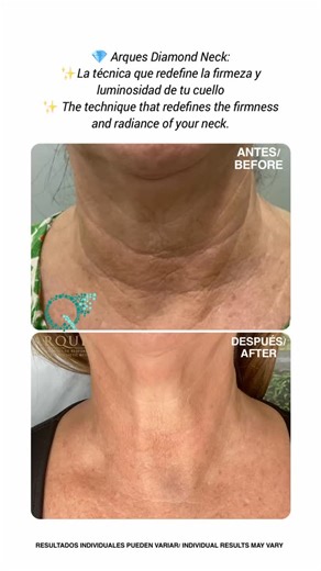 💎 Arques Diamond Neck: ✨La Nueva Técnica/✨The New Technique 👉Un protocolo exclusivo que combina ácido hialurónico y estimulador de colágeno, seguido de neuromoduladores con mesoterapia. El resultado: una piel del cuello más lisa, firme y con un aspecto revitalizado. 👉The New Technique: An exclusive protocol that combines hyaluronic acid and a collagen stimulator, followed by neuromodulators with mesotherapy. The result: smoother, firmer neck skin with a revitalized appearance. | Arques Clinic