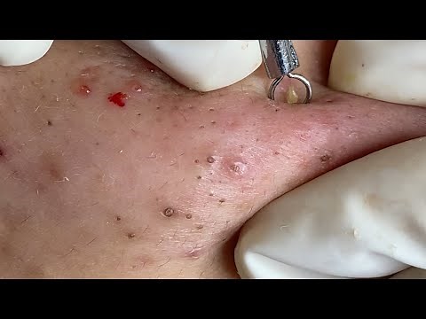 THE SUPER BLACKHEADS POPS | Suri Job 135