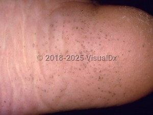 VisualDx - Pitted keratolysis