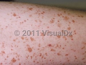 VisualDx - Capillaritis