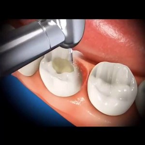 Root canal treatment animated video. 🦷 #endo #dentista #veneers #waxup #dental #dentures #dentistry #teeth #tooth #odontologia #endodontics #orthodontic #dentist #dentalvideo | Dentistry blog