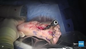 Midfoot Fusion with Hammertoe Correction and Cheilectomy, Moberg and 1st MTP Cartilage Repair