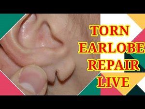 TORN EARLOBE REPAIR LIVE , HOW TO PERFORM SURGERY