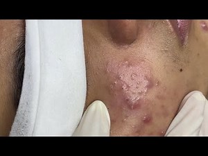 Relaxing Acne Treatment #76| she’s 15 years old