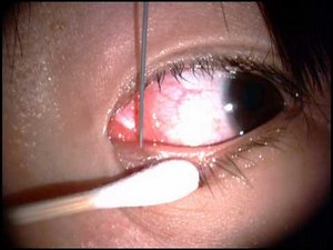 Punctoplasty by needle