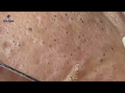 Acne Treatment at the Weekend | GaSpa 20.03.2022