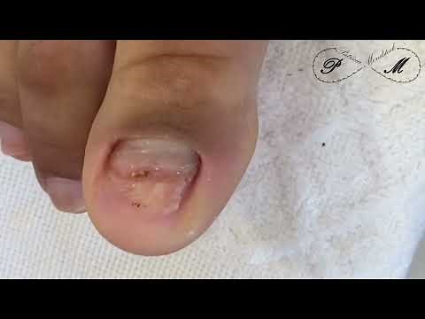 Reconstrução de unha do pé.