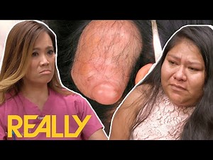 Daughters Bullied Over Mother’s Abnormal Cyst I Dr. Pimple Popper: This Is Zit!