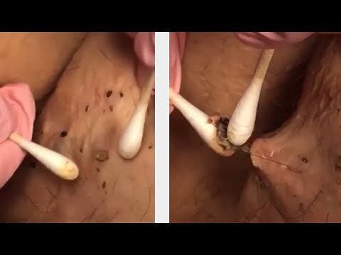 Open Comedones! Blackheads, Blackhead, Black Heads!