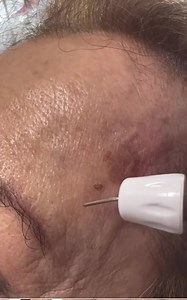 Removing tags pigmentations xanthelasma and all kind of imperfections from the skin within seconds …Last call before summer hurry up and book ur session 03958018 | Carole Zamroud - Z. Clinic Beirut/Dubai | Facebook