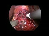 Laparoscopic Heller Myotomy and DOR Fundoplication for Recurrent Achalasia • Video • MEDtube.net