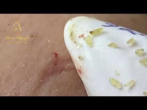 Blackheads extraction (346) | Loan Nguyen