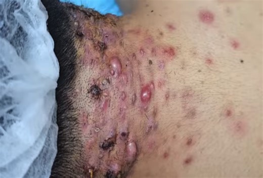 Extreme Neck Acne Popping
