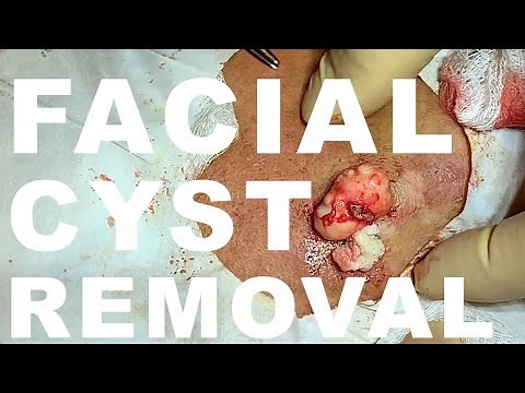 Facial Cyst Removal - Dr. Paul Ruff | West End Plastic Surgery
