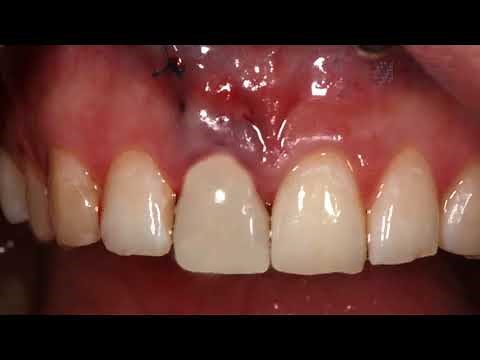 Replacing missing or broken front teeth in just one day! // Case of the Month