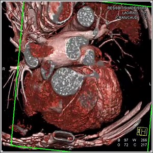 RT Coronary off Left Cusp 3 | CTisus: Cutting edge information on body CT (Computed tomography).