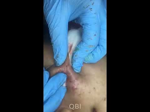 BLACKHEADS REMOVAL & PUSTULES