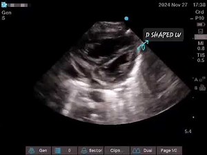 Infracardiac Total Anomalous Pulmonary Venous Return (#TAPVR) #PediatricCardiology #Echo #CHD