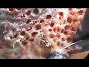 satisfying videos jiggers removal and cleaning jiggers digging