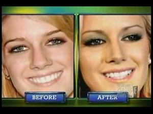 Heidi Montag's "Revenge" Plastic Surgery
