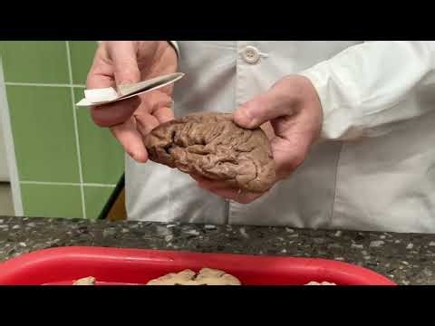 Diencephalon , Telencephalon , Corpus callosum, Fornix, Rhinencephalon (24/05/2026)