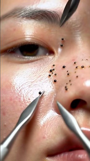 Step-by-step acne removal process #acneremoval #asmr #blackheadremoval #deepcleaning #pimplepopping