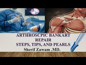 "Mastering Arthroscopic Bankart Repair | Key Steps, Tips, and Tricks"
