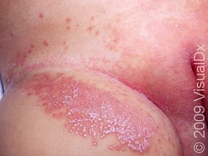 Diaper Dermatitis: Symptoms, Treatment, & Prevention
