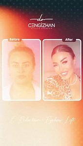 Forehead Reduction and Brow Lift – Before and After