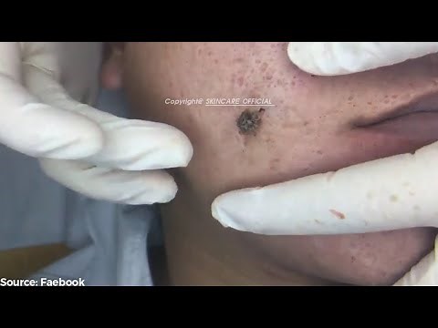 Removing Years Old Blackheads On a Man's Face Easily SS01E01