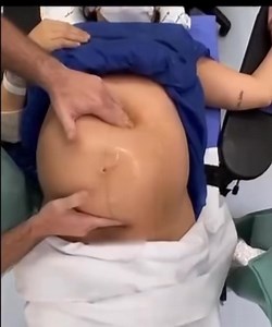 10K views · 59 reactions | L’External Cephalic Version (ECV) est une...