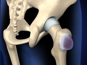 Treating Hip Bursitis in Plano, Frisco, McKinney and Allen